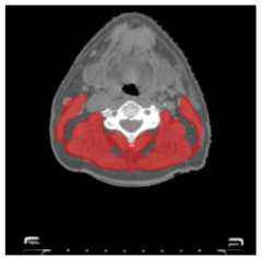 Transfer_learning_sarcopenia_C3