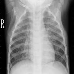 Covid-19-chest-x_rays-images-multi-class-classification-computer-vision-