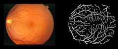 Retinal-Blood-Vessels-Segmentation-and-Denoising