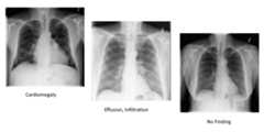 augmented-chest-xray
