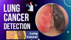 Lung-Cancer-Detection-Project