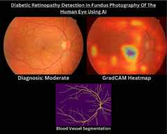 Diabetic-Retinopathy-Detection-Retinal-Vessel-Segmentation