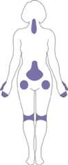 Outline of female body indicating most affected areas