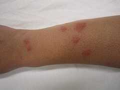 Bedbug bites