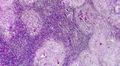 Por qué el cuerpo no destruye las células cancerosas