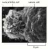 Figure 25-49. A natural killer (NK) cell attacking a cancer cell.