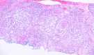 Histological Slide of Squamous Cell Carcinoma, Clear Cell