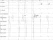 Induction of an Atrioventricular Nodal Reentry Tachycardia