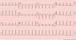 The electrocardiogram shows a narrow complex, long RP tachycardia