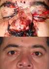 Naso-Orbito-Ethmoid Fracture