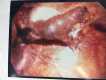Tubal Ectopic Pregnancy