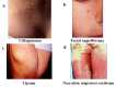 Figure 6. . Cutaneous manifestation of MEN1 syndrome.