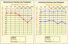 Audiograms - sensorineural hearing loss, and conductive hearing loss audiogram.