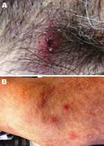 Thumbnail of Images of lesion in the patient caused by bite from lone star tick. A) Erythematous circular lesion in right armpit at site of tick bite with induration and a necrotic center. B) Maculopapular rash involving the inferior portion of the arm. Source: Julie M. Bradley.