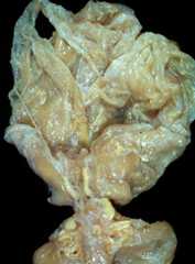 Perinatal asphyxia