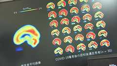 「ブレインフォグ」解消の糸口掴む コロナ後遺症患者の脳を分析「アンパ受容体」の密度が健常者より高いと判明 横浜市立大学病院の研究結果「治療法開発につながる成果」 - ライブドアニュース