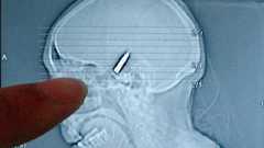 64年の間、ずっと頭の中に銃弾が入っていた女性