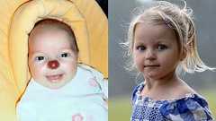 鼻が生まれつきピエロのように真っ赤な幼女、手術に成功し見違える姿に