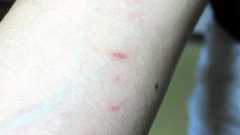 たたかれ、かみつかれ… 障害者施設の職員、絶えぬ傷:朝日新聞デジタル