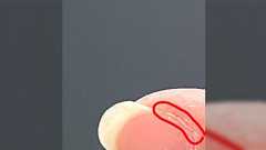 爪と皮膚の間に発生し、硬くて引っこ抜くと血が出て痛いコイツをどうにかしたい「あれほんとムカつく!」