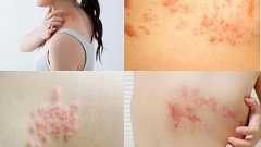 “失明”や“顔面まひ”も! 「帯状疱疹」がコロナ禍で急増 “4万円ワクチン”なら90%予防可能|FNNプライムオンライン