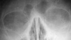 副鼻腔炎 - Wikipedia