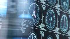 高齢の脳、リチウムでアルツハイマー病防げる可能性 新研究