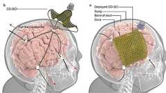「脳を覆う電極シート」、香港チームが開発 数ミリの穴から挿入し展開 ビーグル犬で検証、術後1日で退院