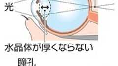 老眼の点眼薬、米で承認 薬物治療に新たな選択肢