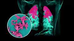 Tuberkulose: Ursachen, Symptome und Behandlung der TBC