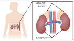 Adrenal insufficiency - Addison's disease