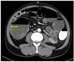 Blowhole Colostomy for Clostridium difficile -Associated Toxic Megacolon