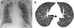 Chest radiograph showing massive hilar and mediastinal lymphadenopathy Chest radiograph showing massive hilar and mediastinal lymphadenopathy