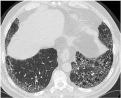 Typical high resolution computed tomography hrct pattern of usual interstitial pneumonia Typical high-resolution computed tomography (hrct) pattern of usual interstitial pneumonia