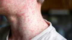 Human skin covered with measles rash.