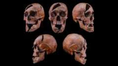 Multiple angles of a skull with large holes and cracks