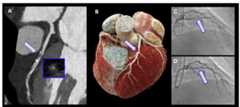 Can Photon-Counting CT Enhance the Detection of Obstructive CAD?