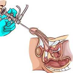 La cystoscopie est notamment pratiquée pour détecter un éventuel cancer de la vessie. © hakan çorbacı, Fotolia
