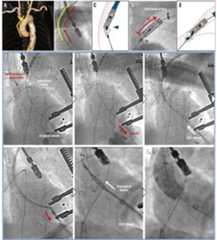 Retrieval of a stuck TAVI device
