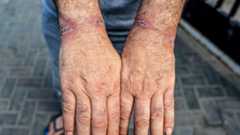 detainee shows cuts on wrists after release