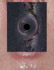 Rugae vaginales with black hole